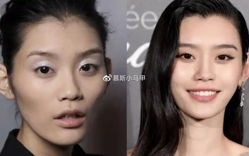 小马甲盘一盘王子文这堪称教科书式的面部填充案例