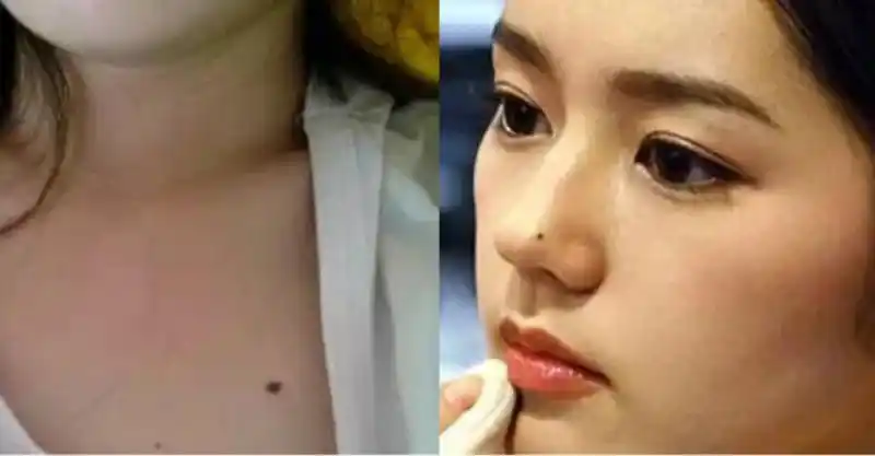 女人一定要去掉的9颗凶痣,你中招了吗