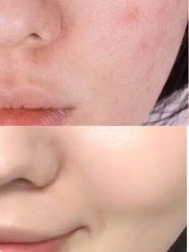 皮肤好坏对自信的影响大吗?有必要做皮肤管理吗?