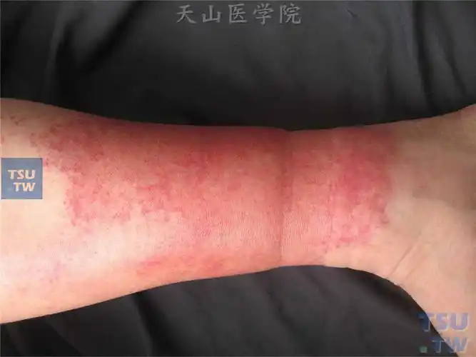 丹毒(erysipelas)症状表现