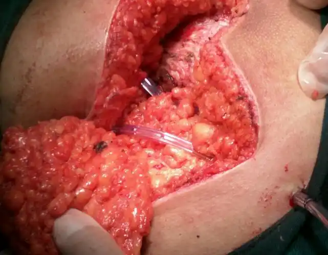 藏毛窦切除一例