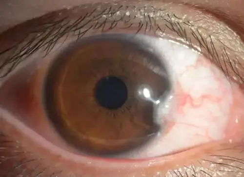 小吴右眼情况这不是老年人才会得的眼病嘛?