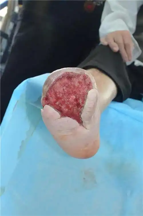 一高龄糖尿病足患者通过保守治疗不截肢治愈案例