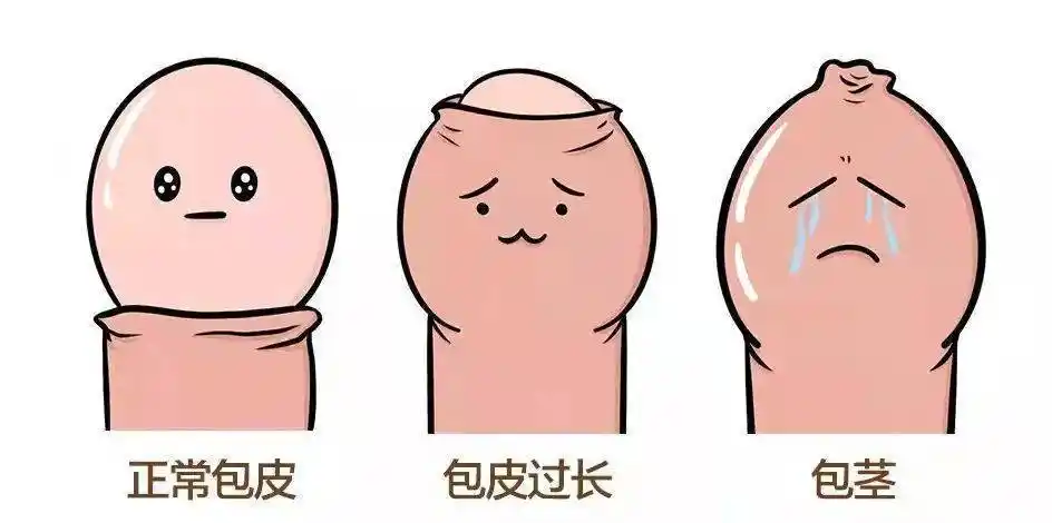 包茎呢,就是包皮口太小,包皮不能上翻露出gui头,也就是像剥不开的香蕉