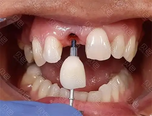 上海罗缘口腔门牙种植
