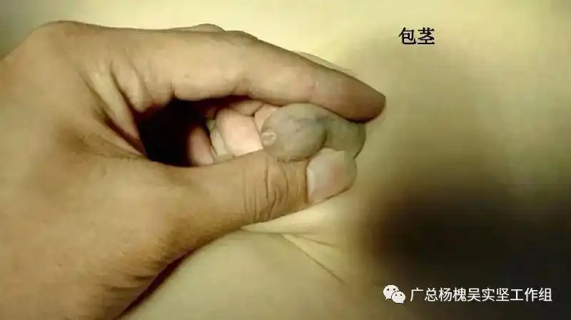 包茎是指因为包皮口狭小或包皮与龟头粘连,包皮不能上翻露出龟头.