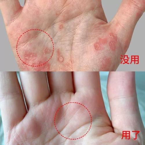 极速c药浴皂牛皮鲜病头皮屑头的药牛皮外用