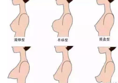 减肥导致胸下垂,可以做假体隆胸吗?_隆胸_隆胸治疗介绍 - 好大夫在线