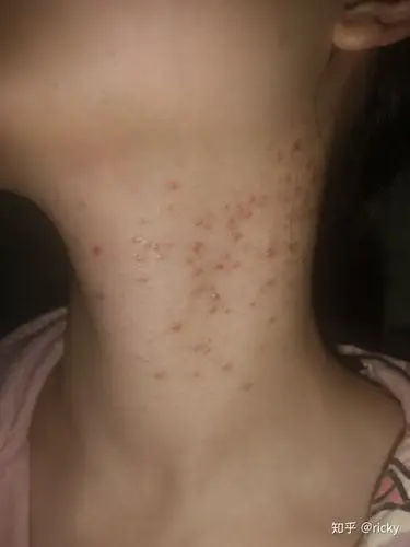 马拉色菌毛囊炎的治疗史