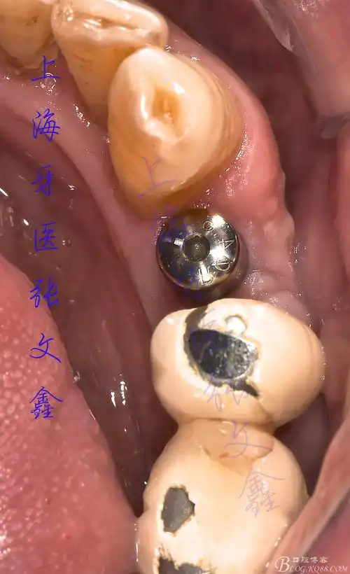 【病例展示】——下颌双尖牙缺失种植修复病例