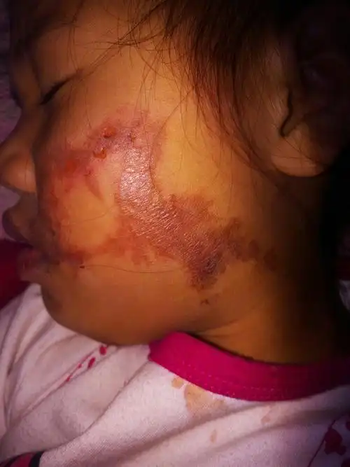 满意回答 你好,现在已经有两天,如果当时没有水泡的话,考虑是一度烫伤