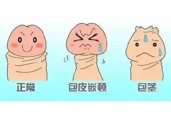 怎么判断自己有没有包皮过长杭州新城医院男科专家咨询