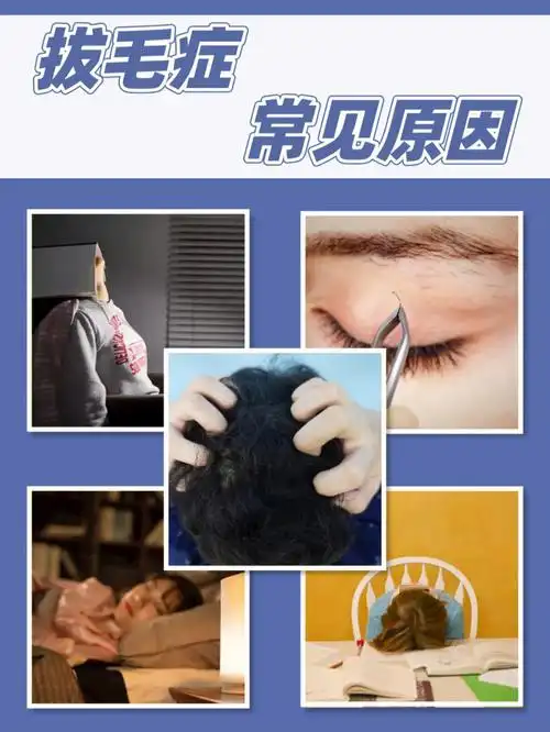 93拔毛症又可称为拔毛癖,是一种重复行为的精神性疾病,也是强迫症的