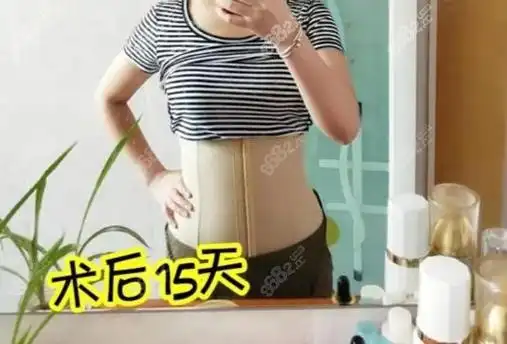 我在上海九院做了腰腹抽脂3000cc,来讲讲我的经历和吸脂费用