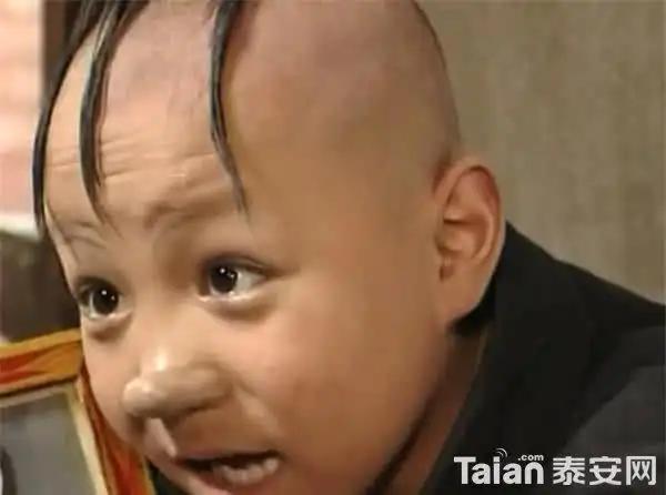 曾演三毛红遍全国却因演戏导致秃顶植发手术缝几百针现在变这样