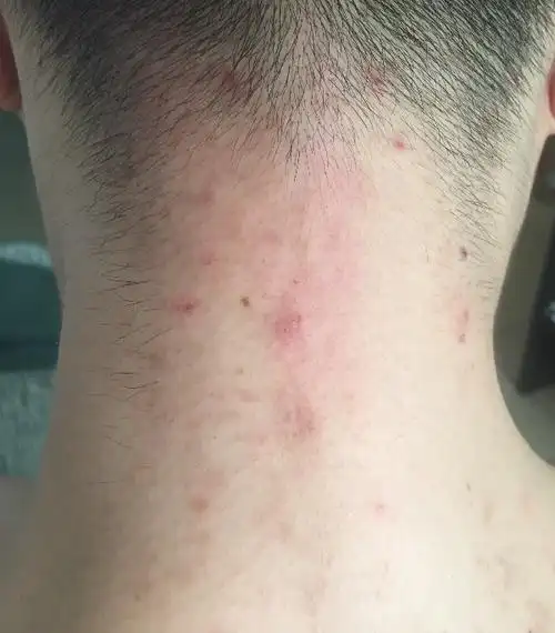 脖子后面一块红痒半年左右了,擦过醋酸地塞米松乳膏,没什么作用,就