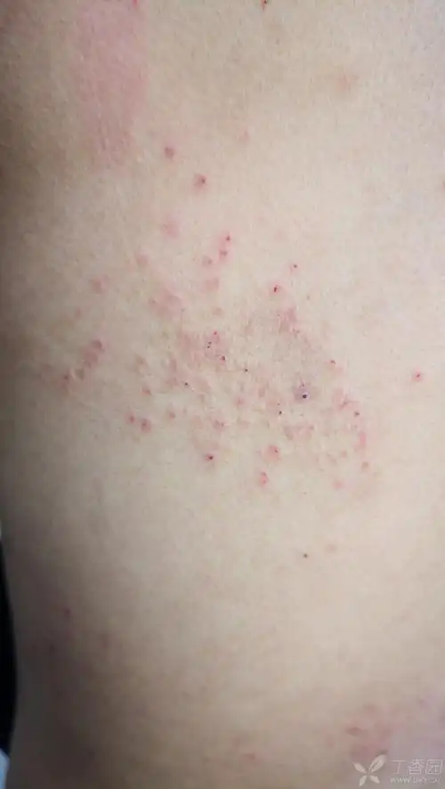 疥疮? - 皮肤与性传播疾病讨论版 -丁香园论坛
