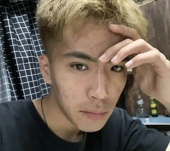 男生皮肤粗糙脸上有痘毛孔粗大如何护肤2个月祛痘细腻肌肤收缩毛孔