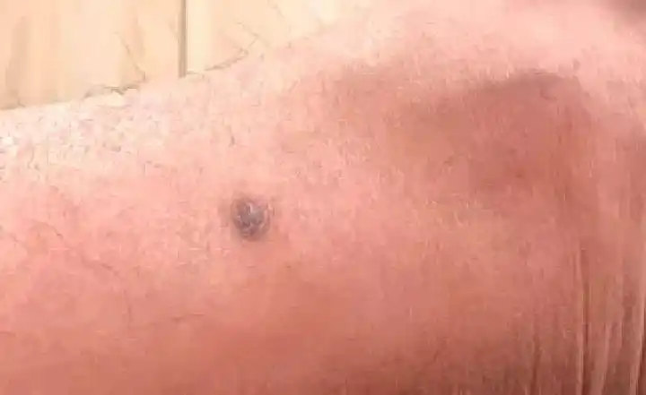 身上有这种痣当心癌变医生分析了100多颗黑痣快来对照下