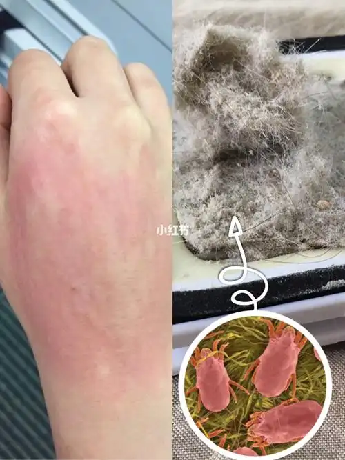 最近南方多地连续下雨74长期不晒被的阴雨天是螨虫滋生的绝佳时期