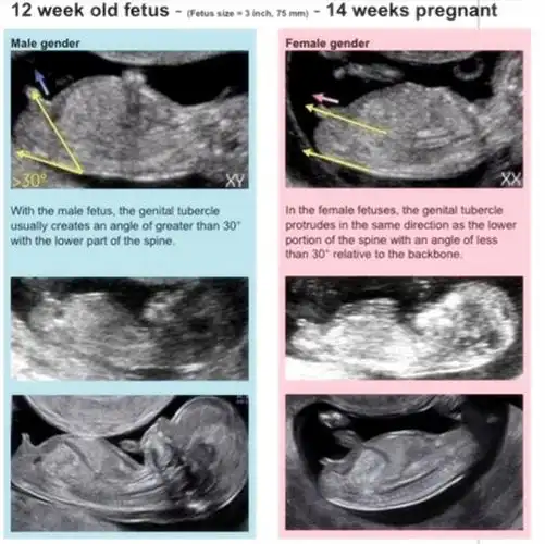 "nub"实际上就是指胎儿的"生殖节",一般在胎儿11-13周的时候,生殖器官