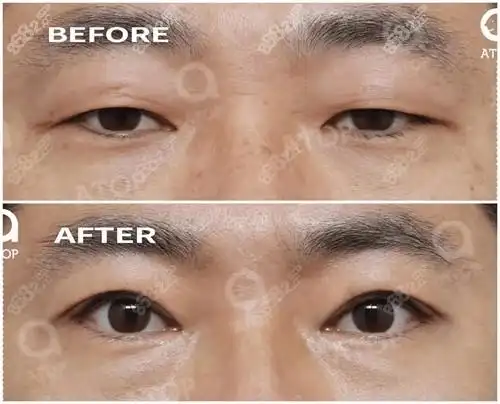 韩国爱她和珠儿丽哪家割双眼皮好速看技术优势对比