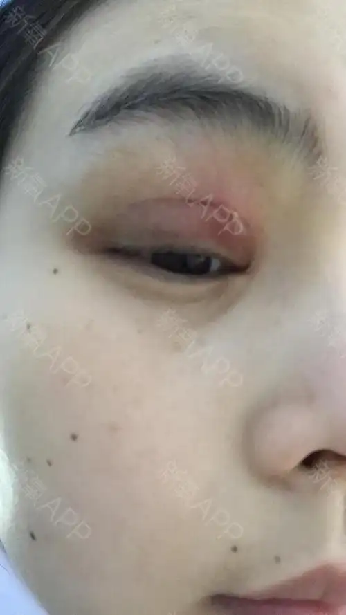 这是线头反应的那一天,开始不晓得是线头反应,以为只是单纯的