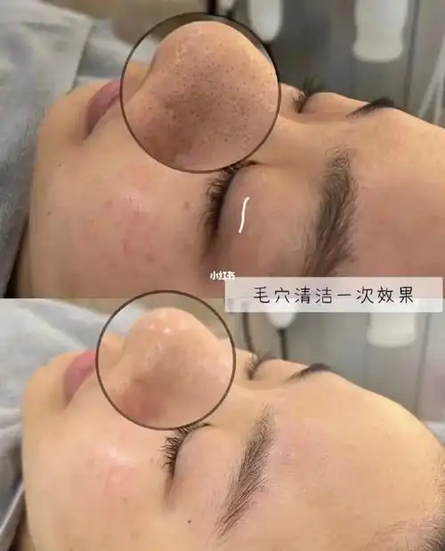 为什么要做小气泡毛孔清洁管理?