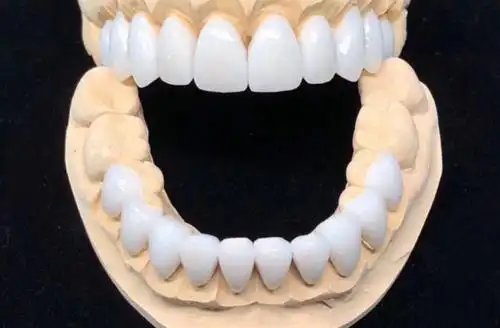 重庆牙齿做过贴面还能带牙套吗