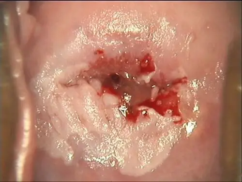 妇科宫颈糜烂排出物图片_有来医生