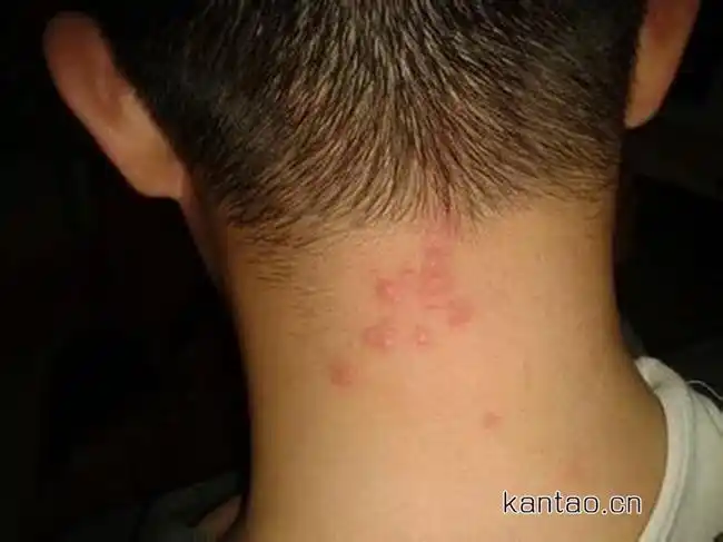 毛囊炎是怎么引起的 毛囊炎的病理原因及症状分析不得不知