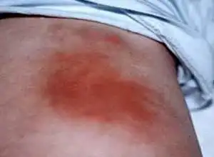 原因,皮下脂肪坏死怎么办-其他科室-其他综合-症状查询-寻医问药-xywy