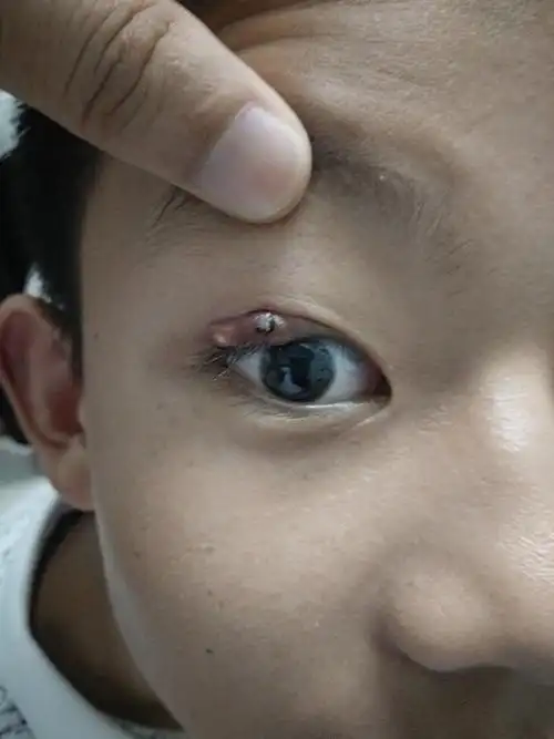 睑腺炎俗称麦粒肿中医名针眼的个人经验治疗