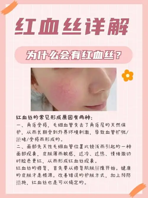 春天你的红血丝越发红了吗红血丝详解