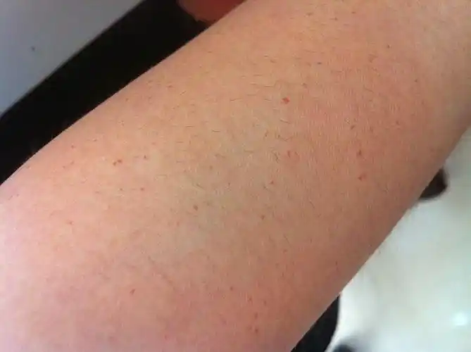 皮肤红点几年前就有了,最近好像有点多起来了,不痛不痒,红点颜色实际