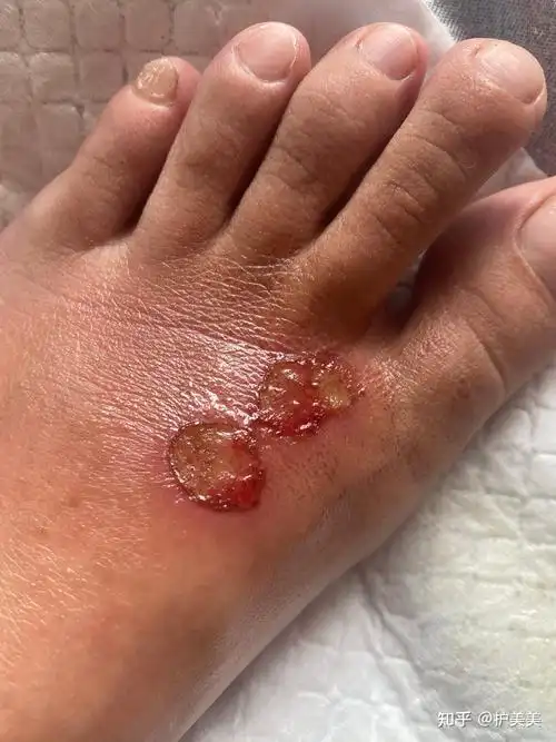 脚面烫伤恢复过程,有同样类似经历的,请进,请指导