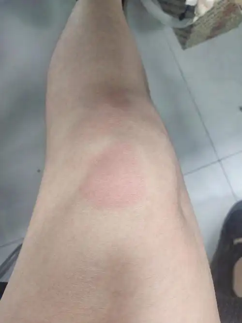 腿不小心磕到了~然后就有一大块的红斑一样的东西可是我晚上还有点事