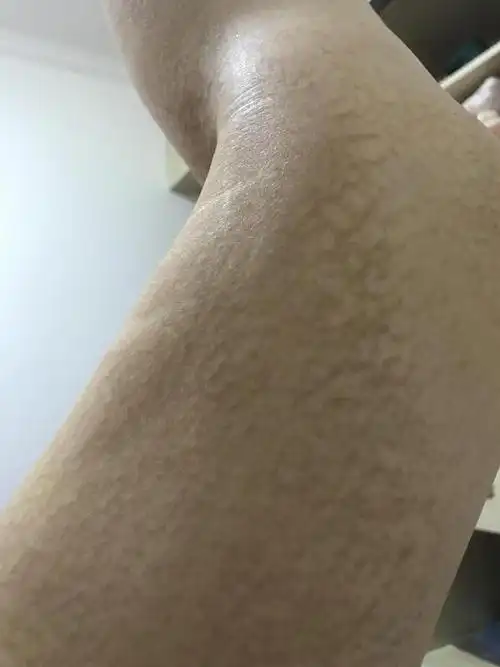 疥疮之后,皮肤出现干燥脱皮,现在脱皮好点了,两个腿都出现了这样的