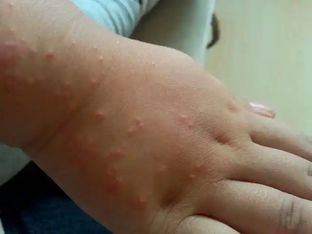 孩子过敏起疙瘩怎么办三岁孩子过敏起疙瘩怎么办