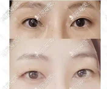 韩国来丽整形双眼皮改单眼皮成功对比图