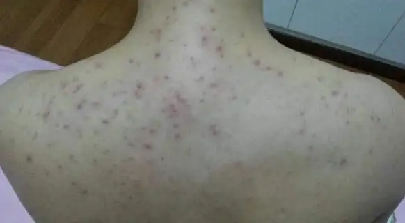 上万螨虫在后背乱爬引起这4种情况不需要找医生3招除螨