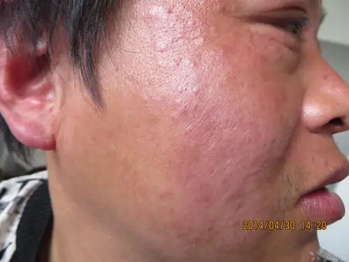 皮肤与性传播疾病讨论版 -丁香园论坛