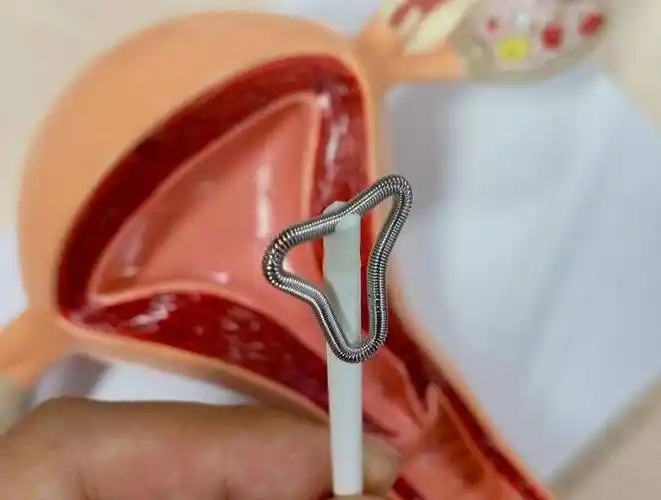 避孕环是什么抑制环是啥