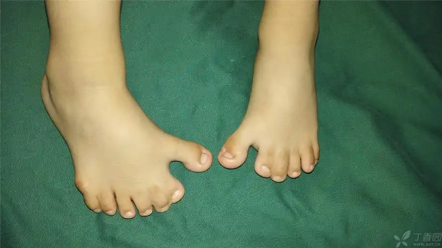 左足跖趾骨发育畸形,显示第6跖趾骨,第2跖骨发育不全.