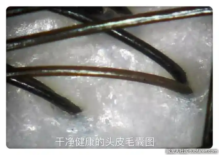 正常头皮毛囊图