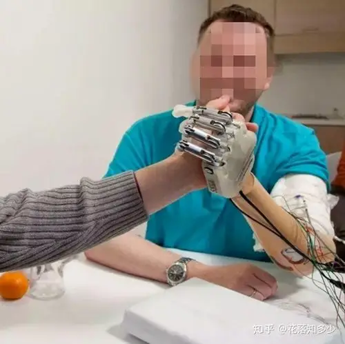 优邦假肢-四步带你认识腕离断假肢