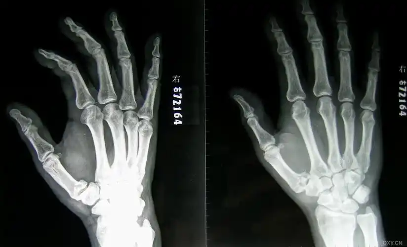 bennet 骨折 - 骨科 -丁香园论坛