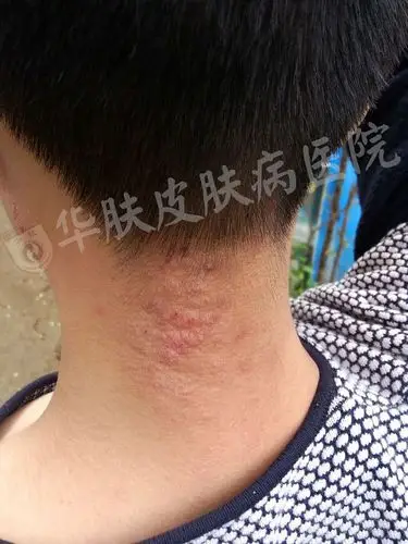 华肤顽固神经性皮炎康复案例