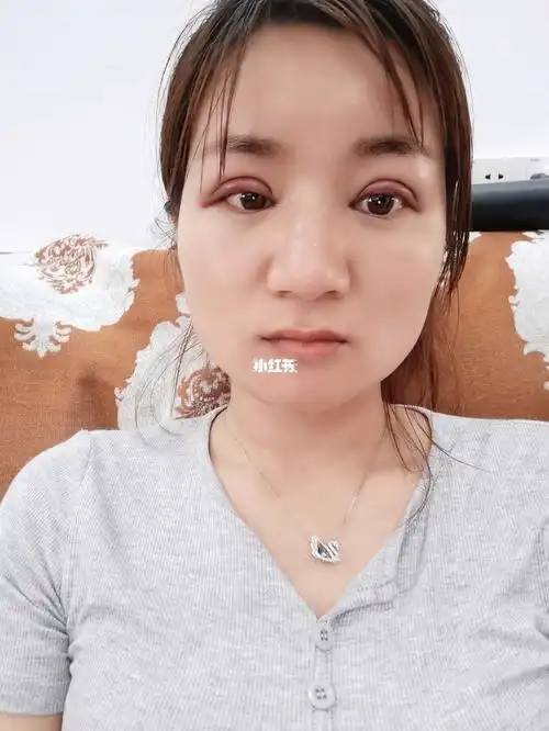 刚刚做的双眼皮,最后一张是没做之前的_双眼皮_美妆_医美整形