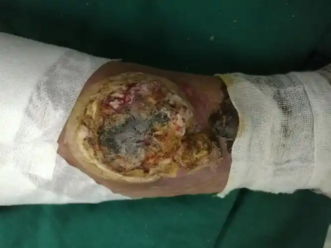 肿瘤冷冻后即刻图片(正面)该图片可能引起不适继续查看肿瘤冷冻后即刻